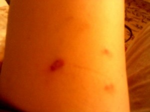 Morgellons on skin
