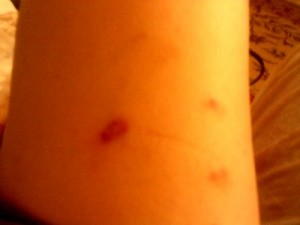 Morgellons on skin