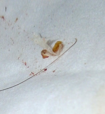 Woman Suffers Pain and Skin Damage from Parasitic Infestation