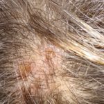 Yellow and Red Marks on This Woman’s Scalp Cause Itchiness: Where She Can Seek Medical Advice