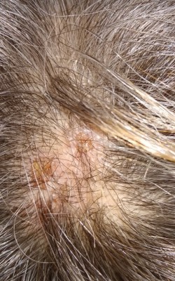 Yellow and Red Marks on This Woman's Scalp Cause Itchiness: Where She Can  Seek Medical Advice - All About Worms